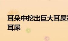 耳朵中挖出巨大耳屎视频 男子耳朵掏出巨型耳屎 